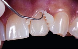 Zementüberschussentfernung am Zahn